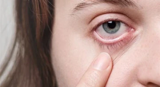 Ptose Palpebral: Você Sabe o que é?